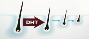picture of how steroids & dht accelerate hair loss